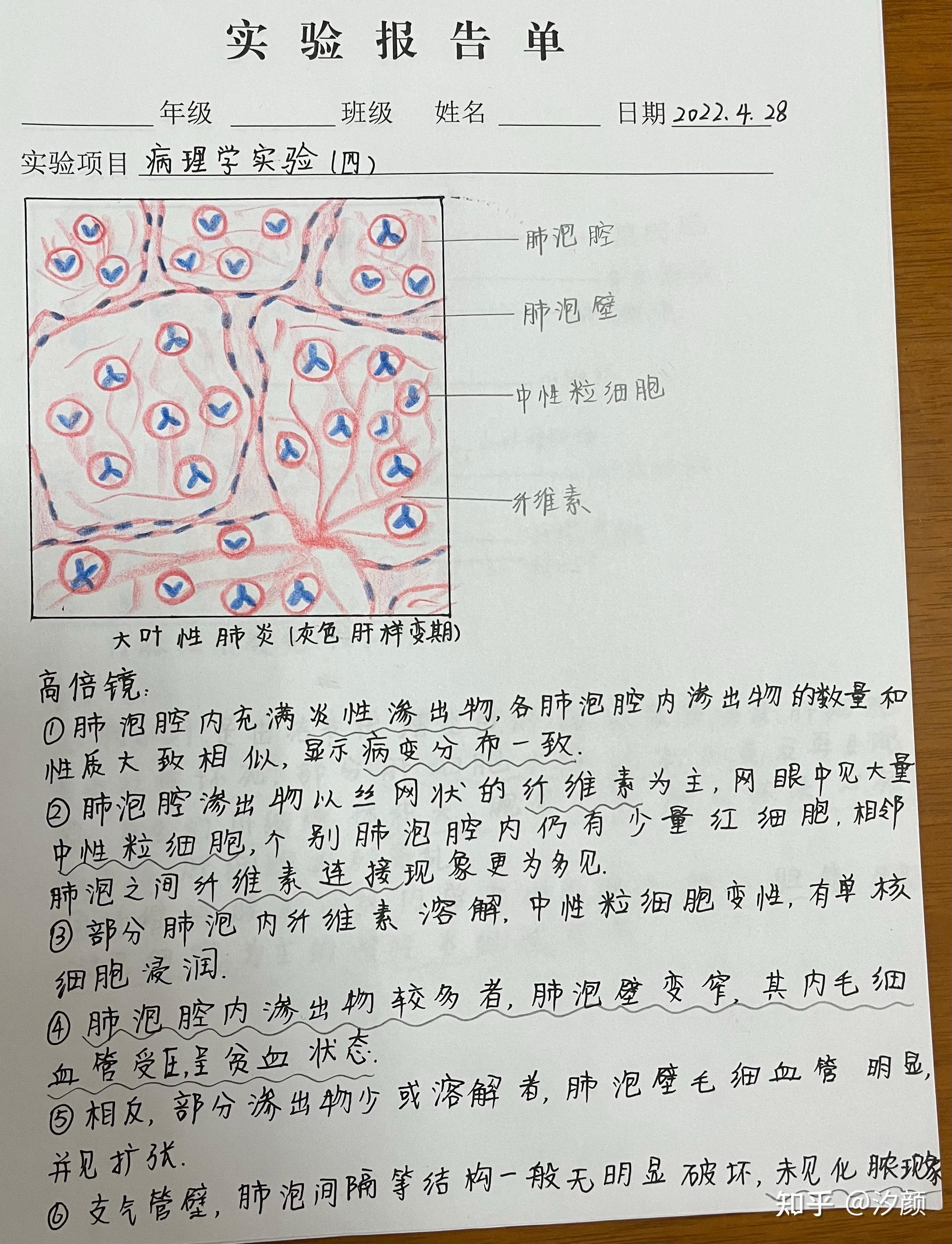 肠上皮化生红蓝铅笔图片