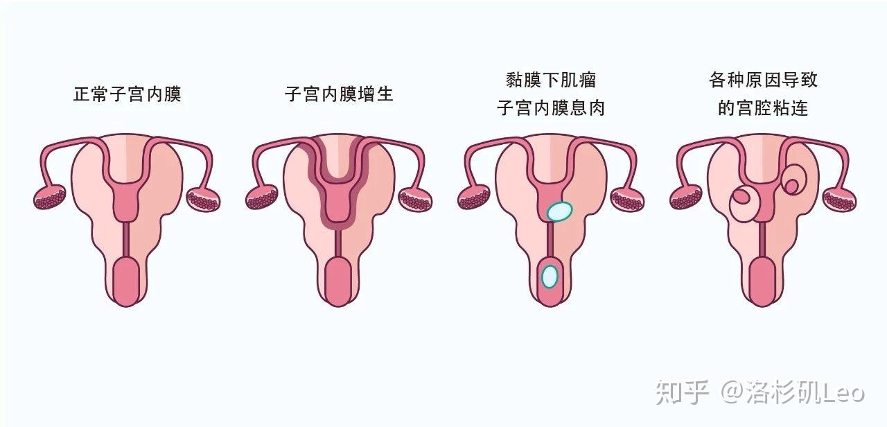 2%,这些异常包括宫腔粘连,子宫内膜息肉,子宫黏膜下肌瘤,子宫畸形以及