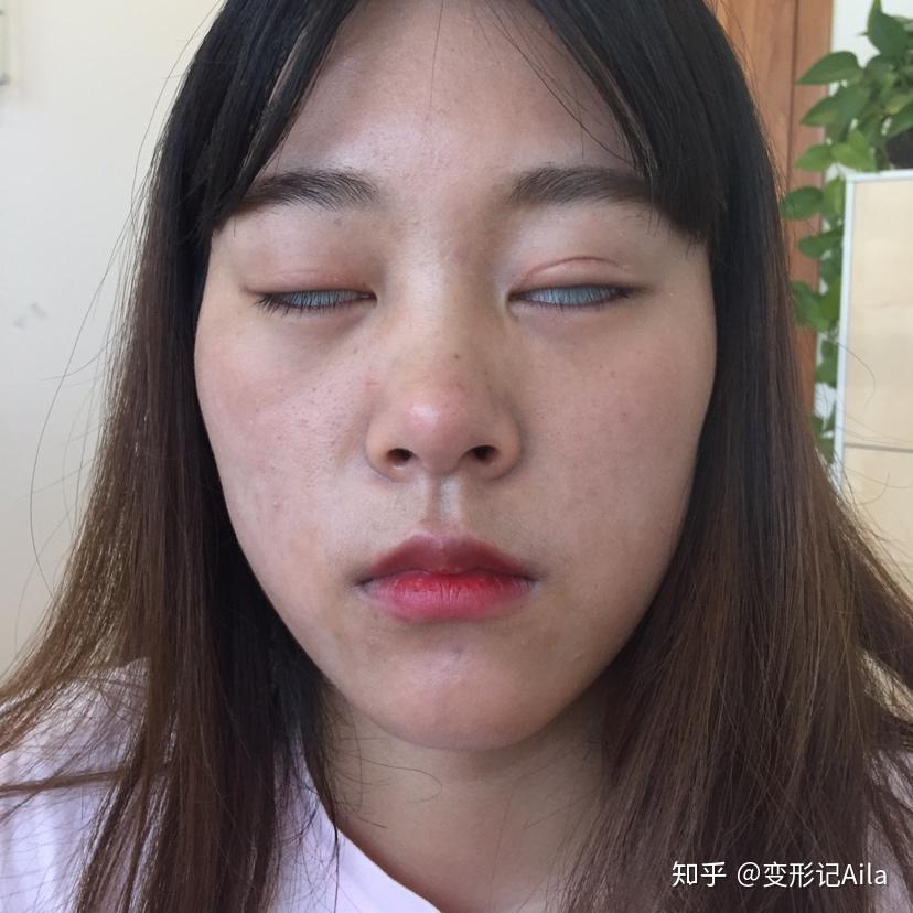 什么是失败双眼皮 v2-1c9cb64a448307a04d76837156ff99ac_r.jpg