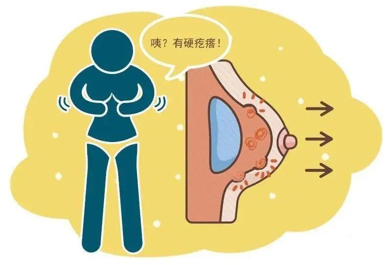 什么是乳腺结节