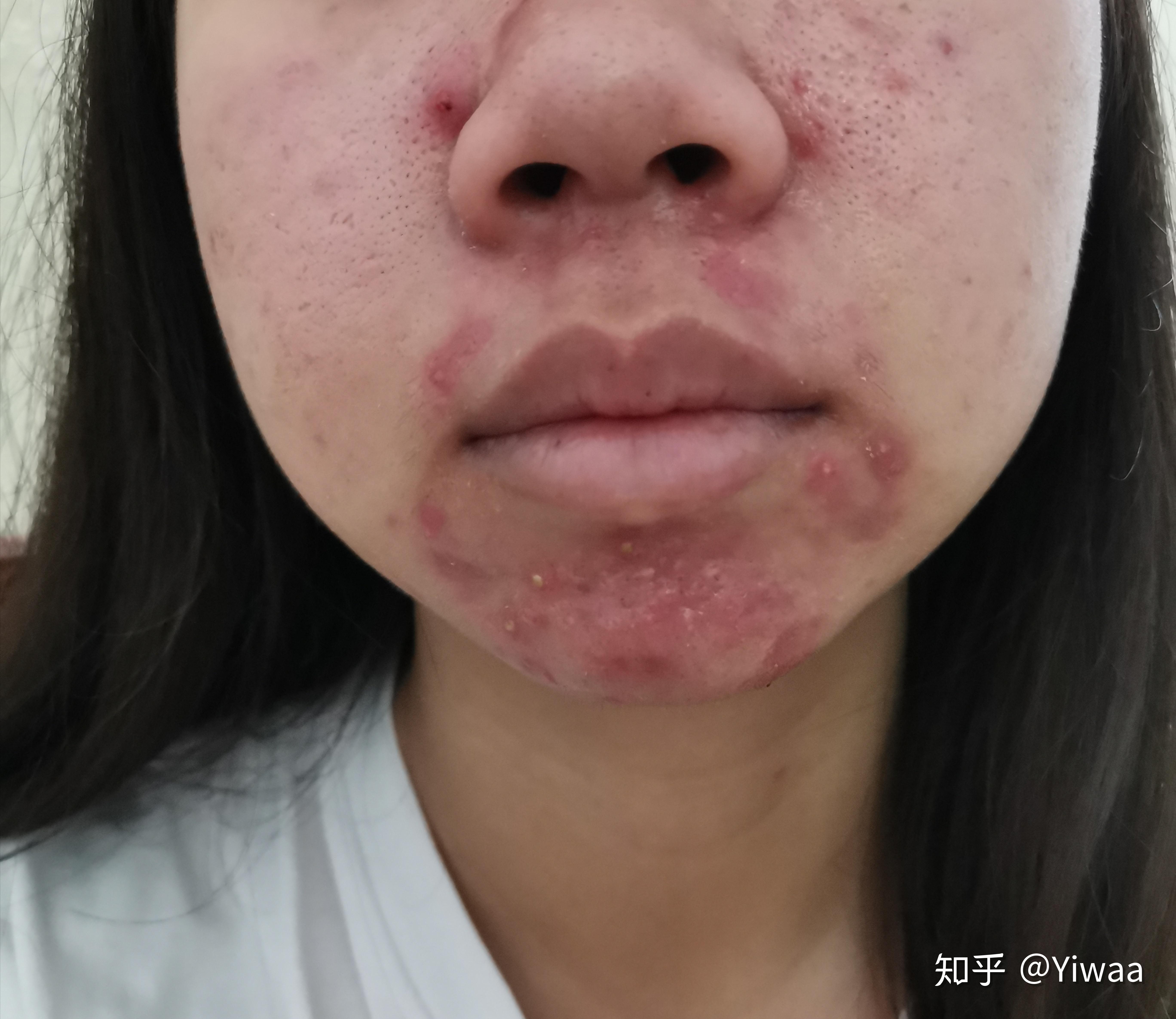 记录服用泰尔丝异维a酸软胶囊