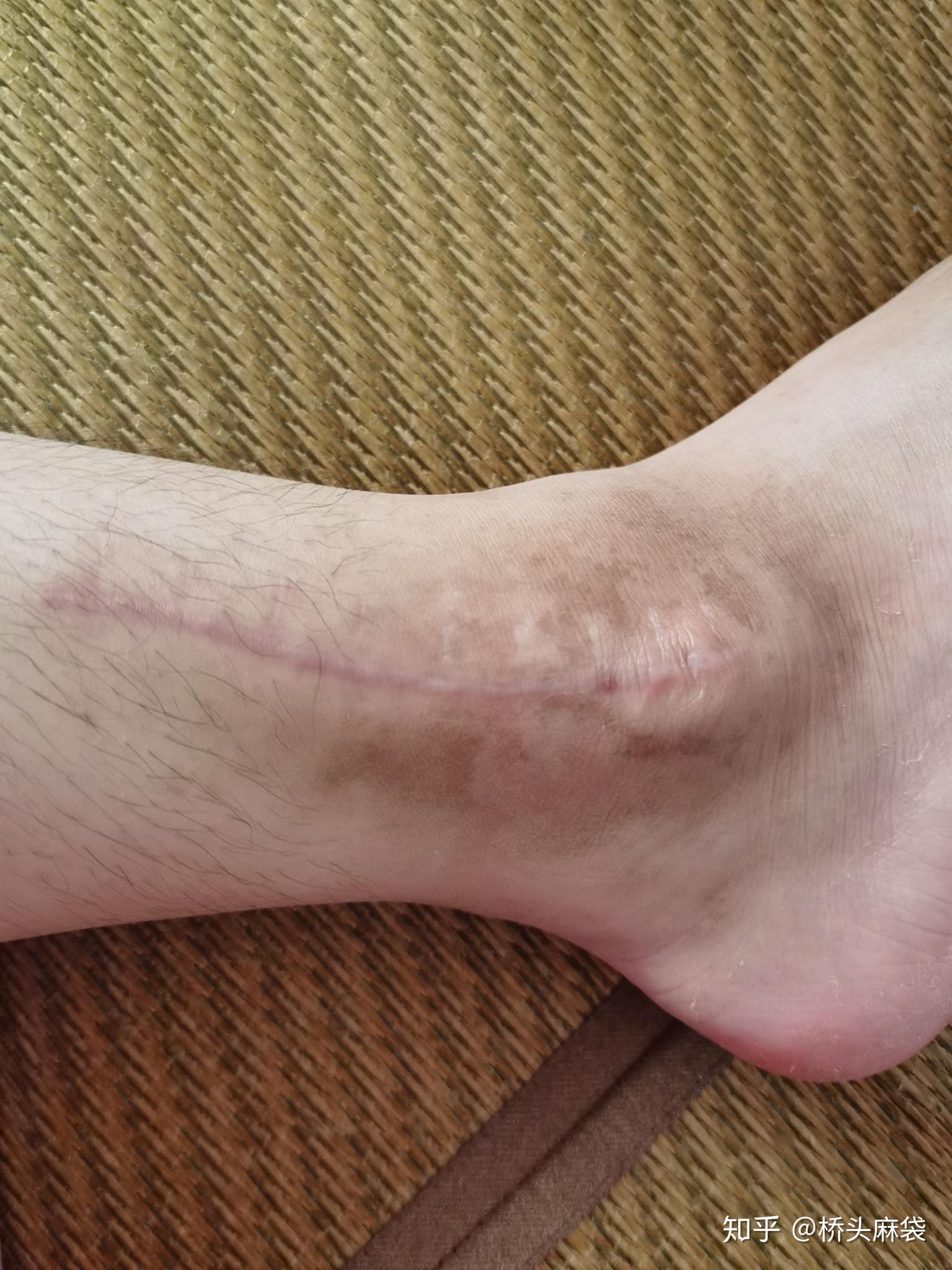 脚踝骨折是一种怎样的体验? - 知乎