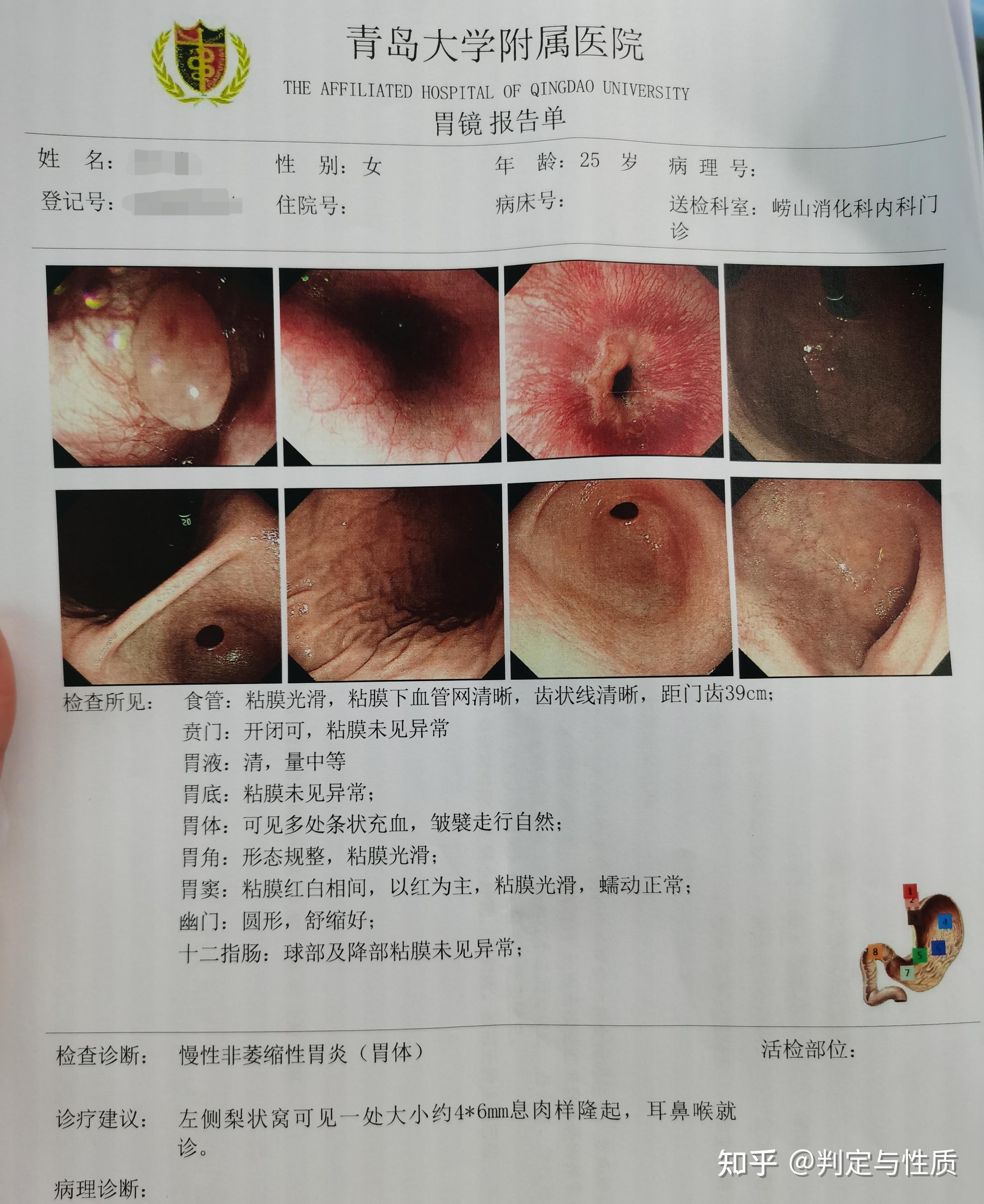 普通胃镜痛苦吗
