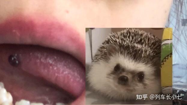 急问,舌头下突然长一个血泡是怎么回事? - 知乎