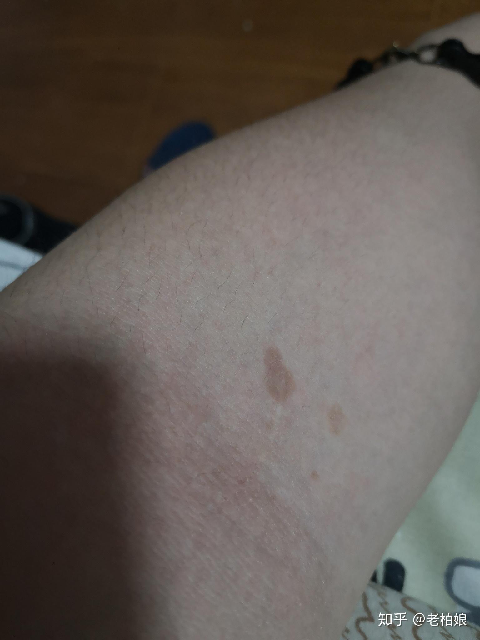 胳膊上长这种斑请问是什么斑怎么去除急求