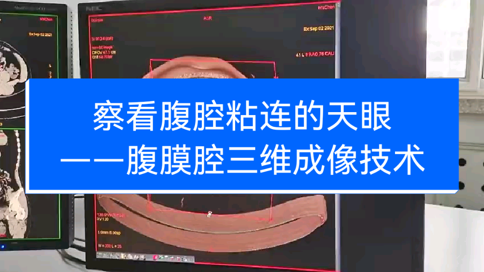腹腔粘连和肠粘连的因果名实辨析 - 知乎