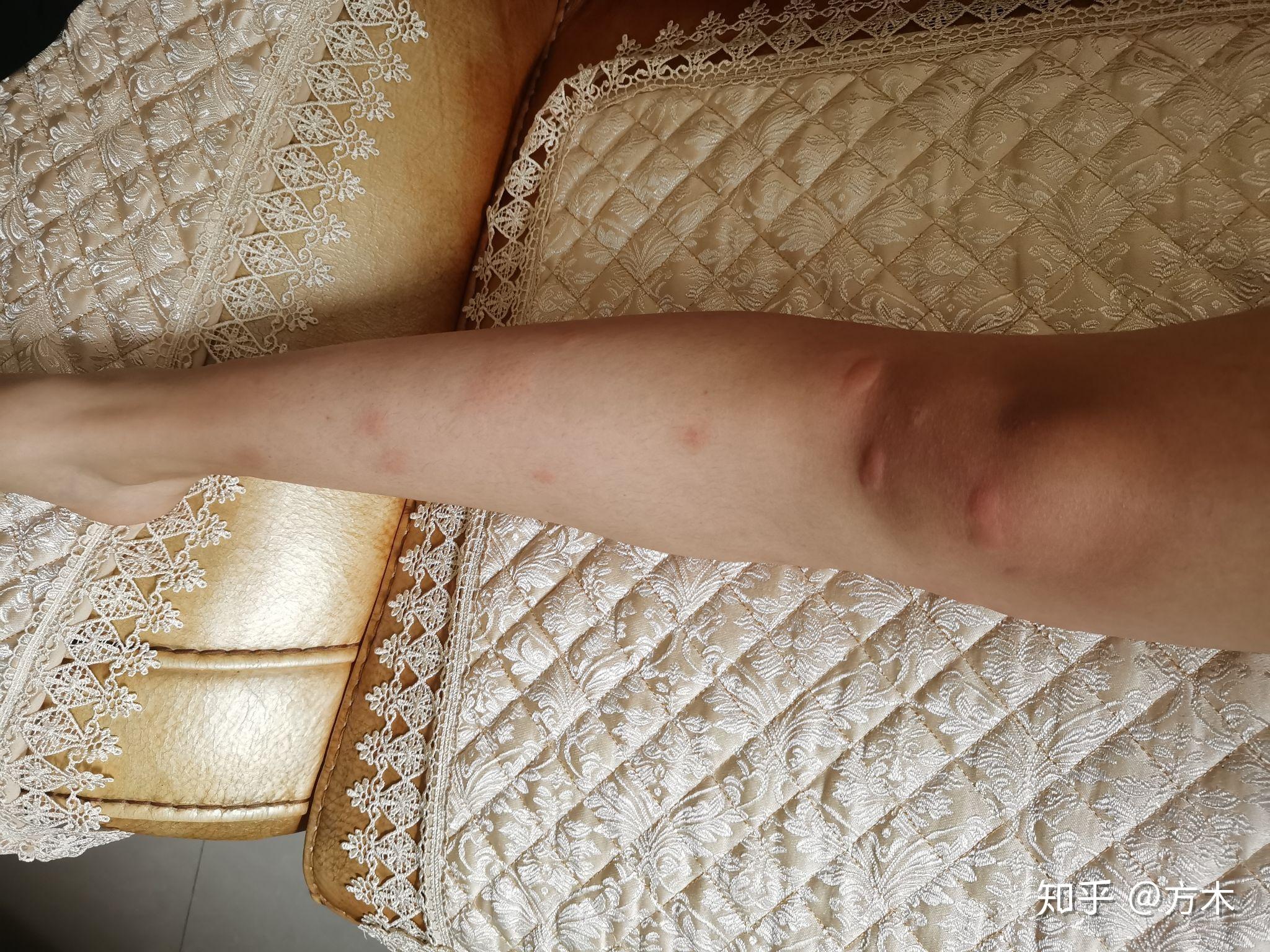 你们被蚊子咬过最大的包有多大?咬的位置在哪里? - 知乎