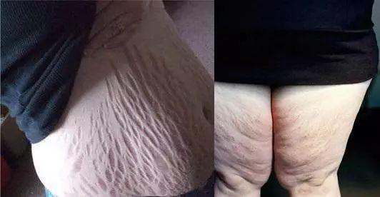 怎么去掉肥胖纹