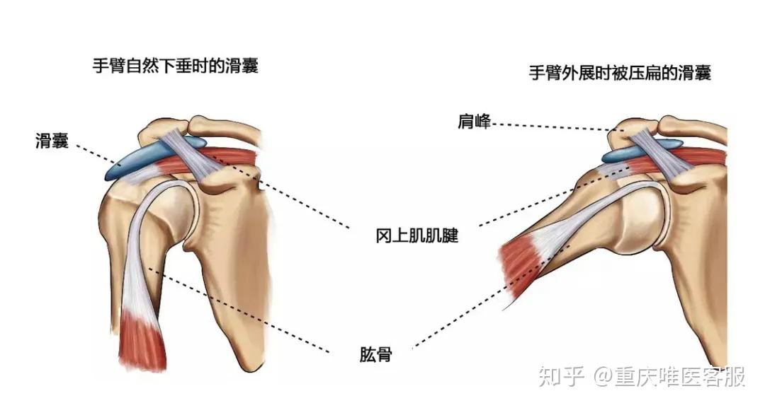肩峰下间隙内结构异常或盂肱关节不稳导致在肩上举过程中,肩袖或二头