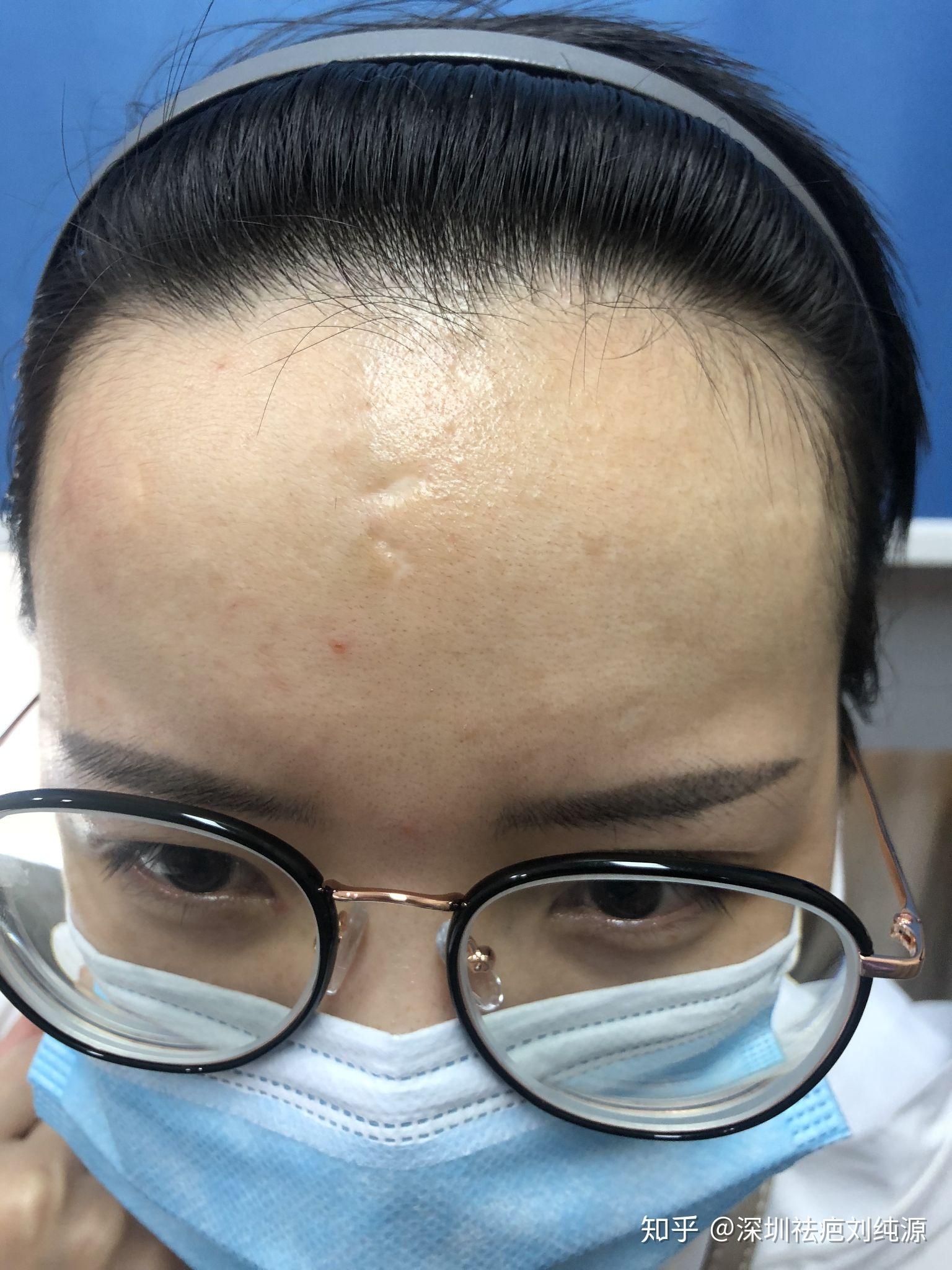 四五年前药水点痣后留下的疤痕还能去得掉么? - 知乎