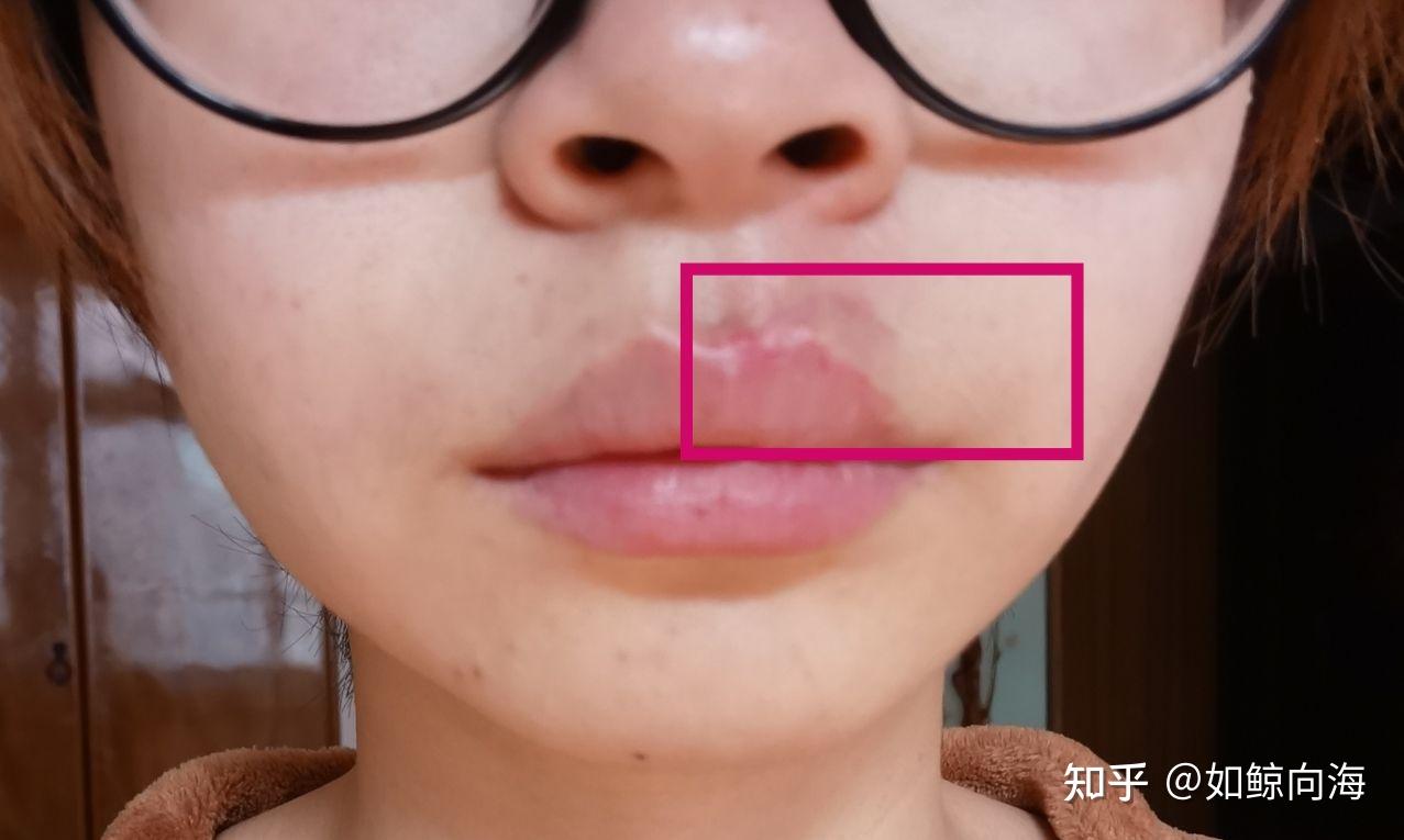 嘴唇变形怎么办?