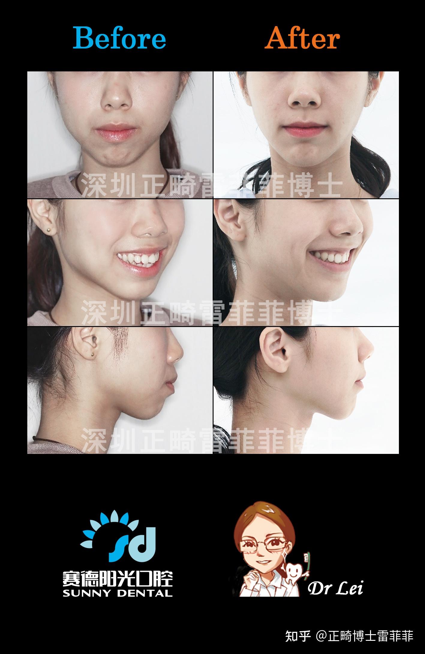 怎样判断嘴凸是骨性的还是牙性的? - 知乎