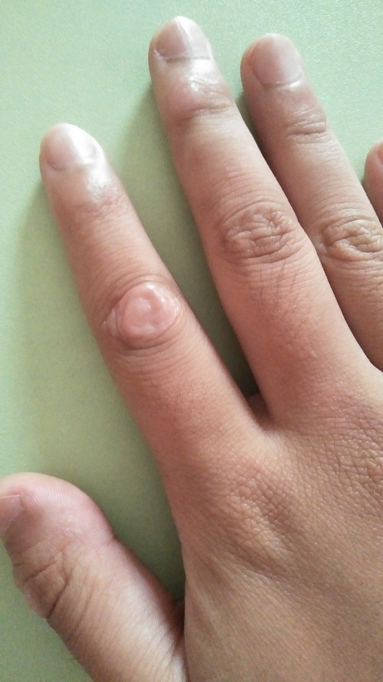 手指关节出皮肤变厚原来的纹路消失为什么会这样? 