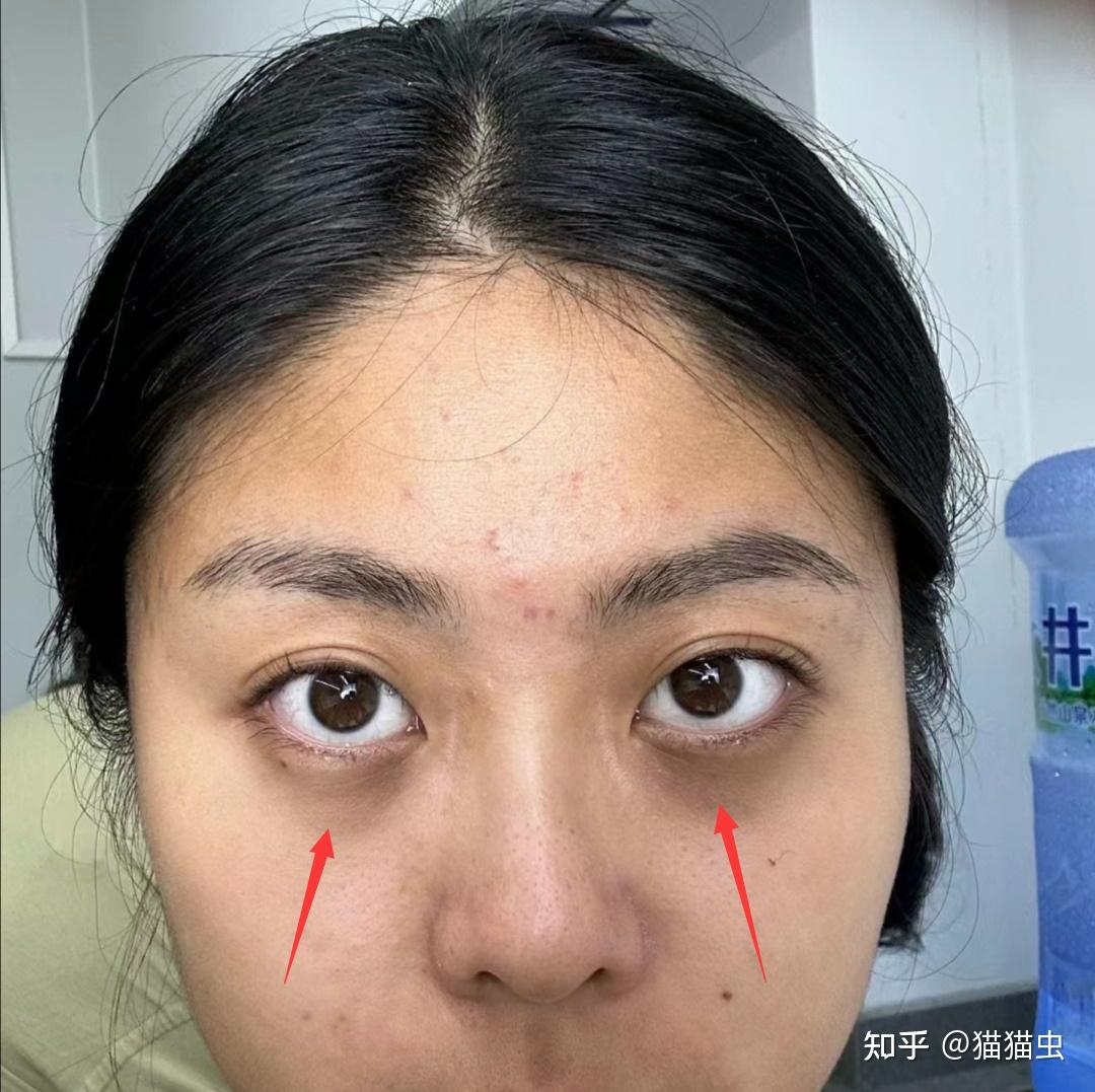 多睡觉能把黑眼圈睡没吗?