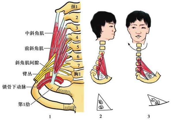 斜角肌综合征 zhuanlan.zhihu.com