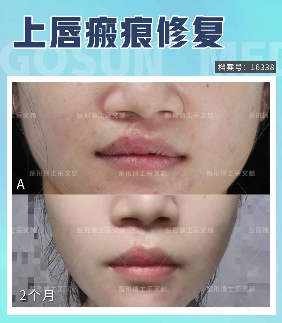 案例分析26岁女子唇裂术后唇红缘不齐术后2个月效果良好