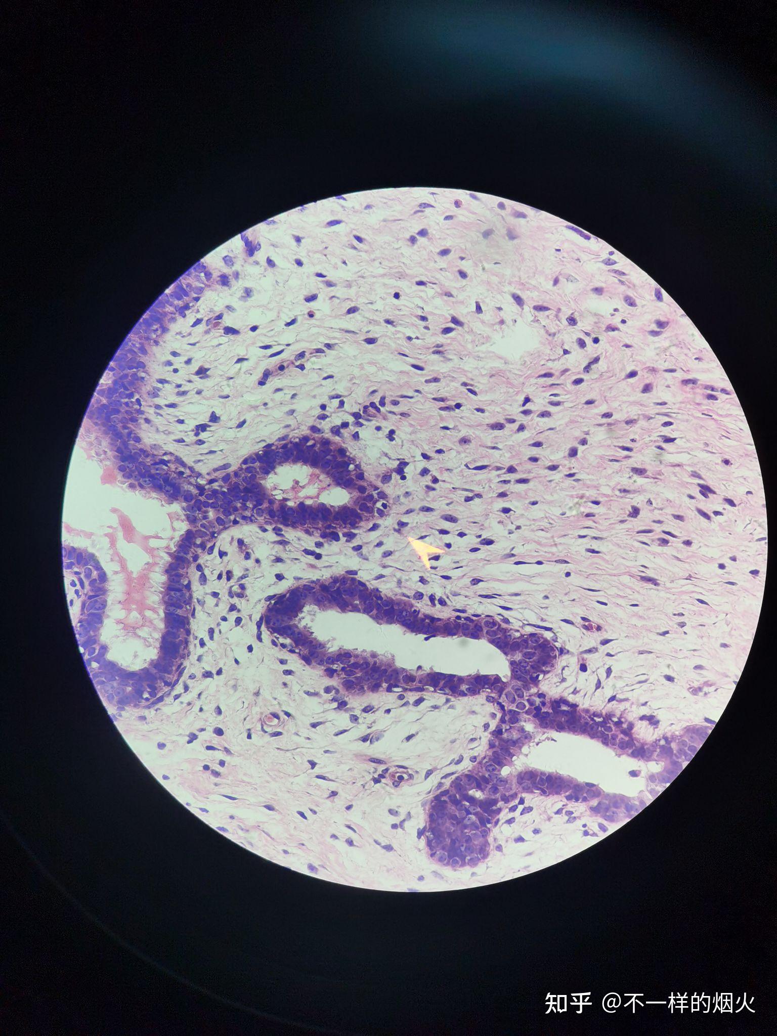 乳腺纤维腺瘤的镜下观