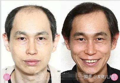 写给打算做植发的兄弟们：植发手术过程、植发营销套路、植发效果、植发技术..... - 知乎
