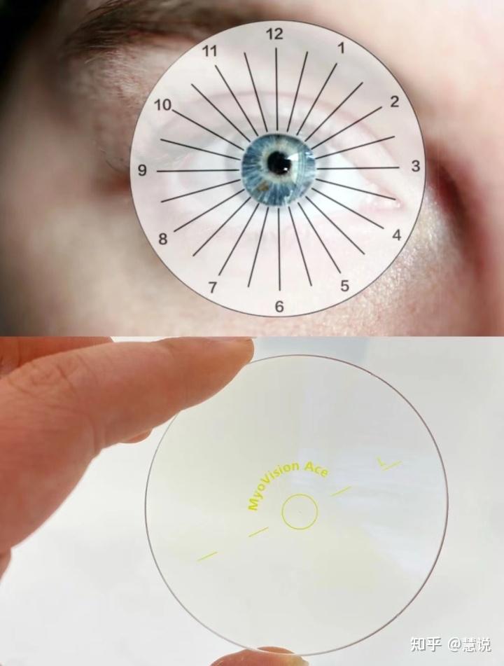 关于“散光”的详细科普，请收藏保存 - 知乎