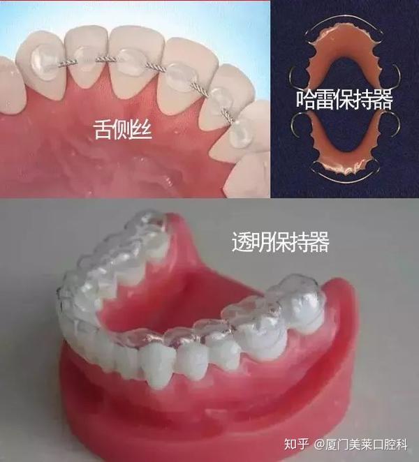 厦门牙齿矫正后为什么要佩戴保持器?那种保持器好呢? - 知乎