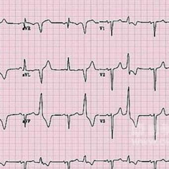 频发性室性早搏图片图片