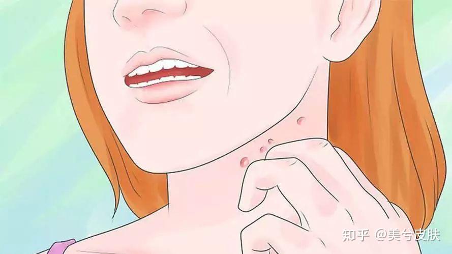 毛囊炎是什么原因引起的？这四种人最易患毛囊炎！ - 知乎