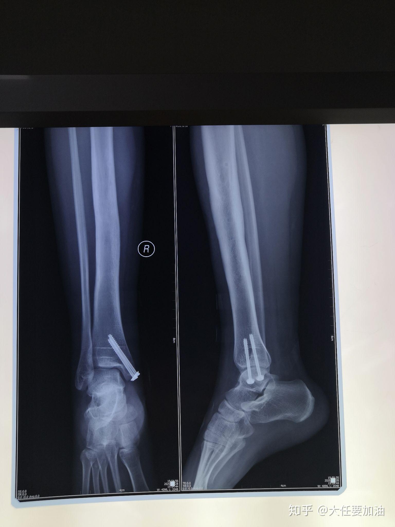 脚踝右侧胫骨远端骨折康复历程