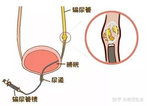 肾结石最快的排出方法图片