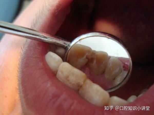 氟斑牙又称氟牙症或斑釉牙,是慢性氟中毒病早期最常见而突出的症状