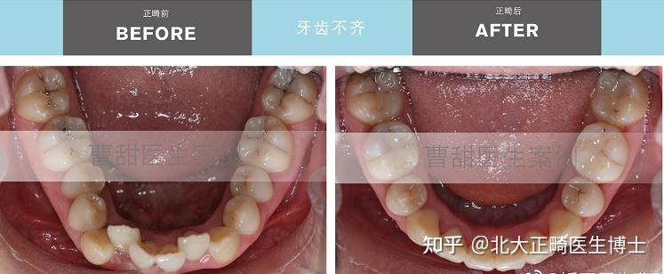 鄭州隱適美矯正醫生曹甜牙齒不齊咬合不好有矯正的必要嗎