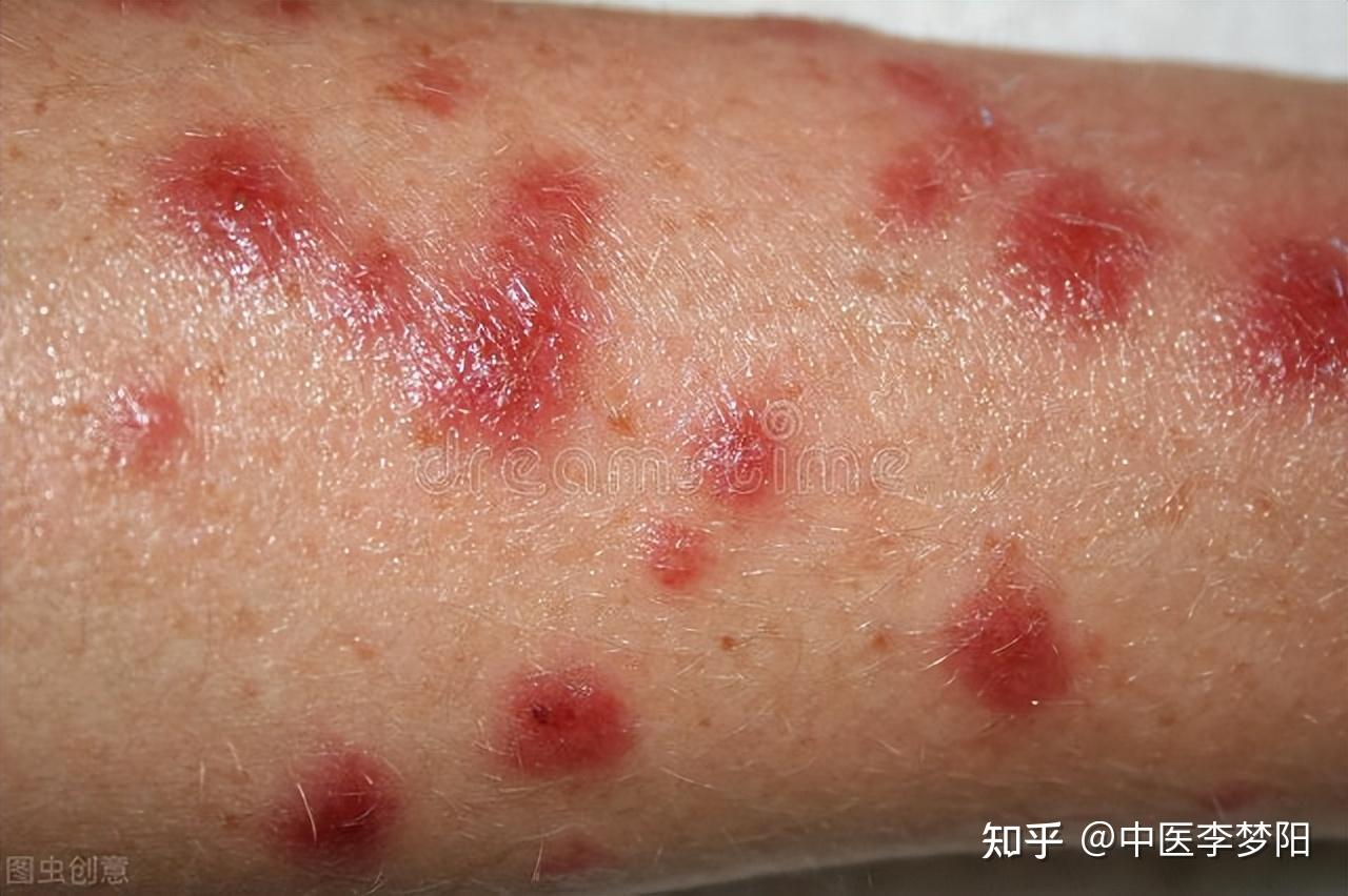 而这种现象多是因为体内阳气旺盛的,以至于吃点燥热的食物就上火,而血