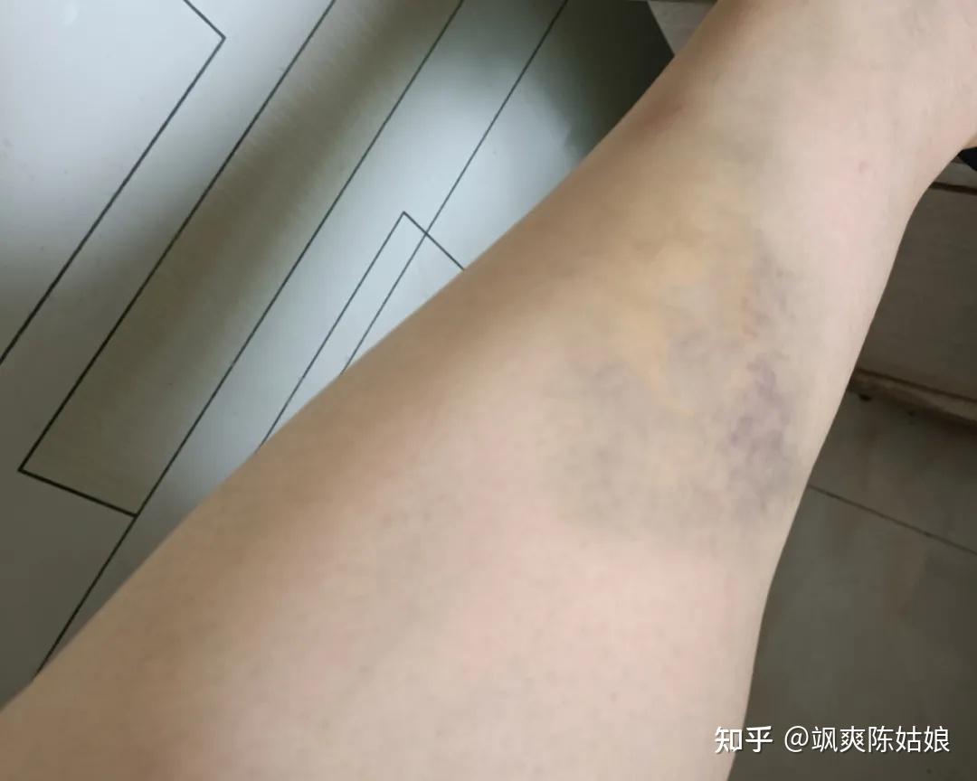 晚上洗澡时,发现小腿处一片红肿,显然是在哪里碰到了,怪不得一直疼,想