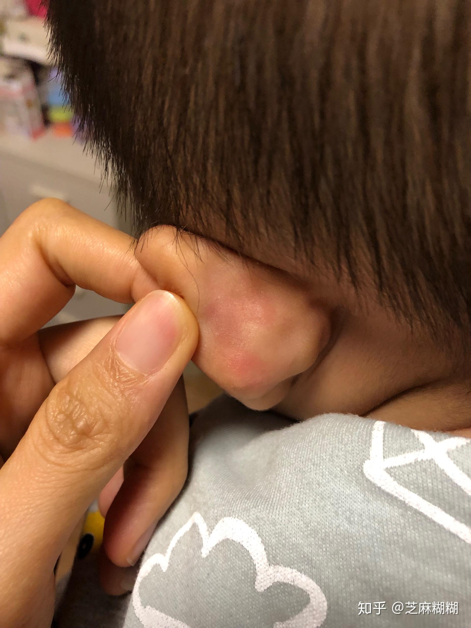 宝宝长荨麻疹了我该怎么护理