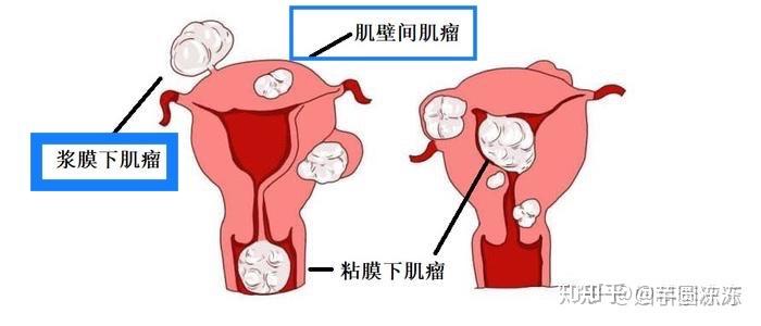 子宫肌瘤腹腔镜手术经历