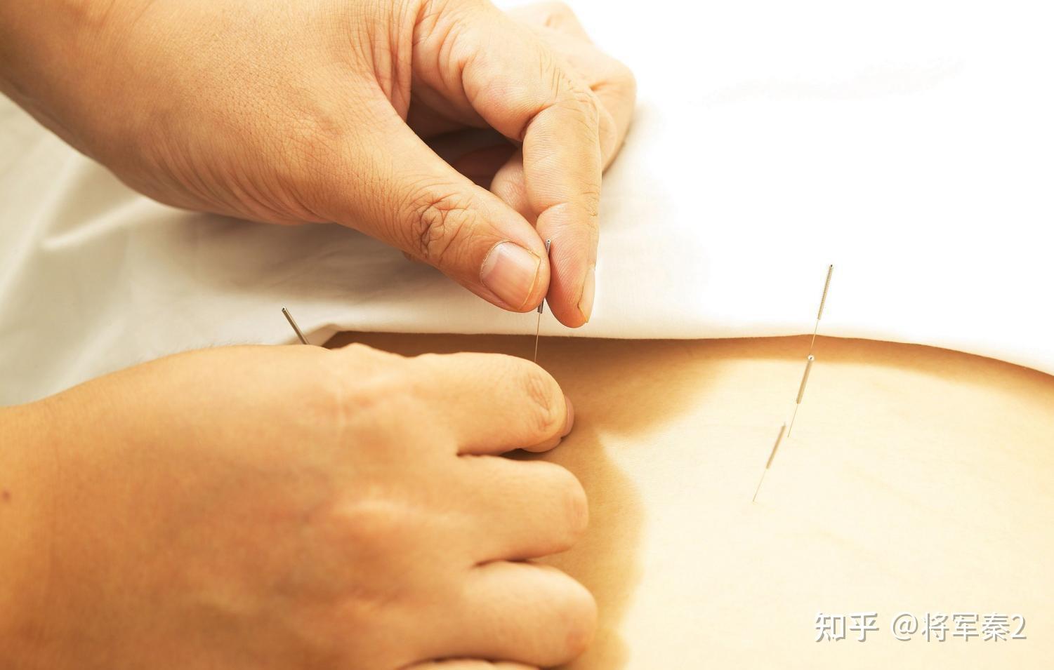 水针灸是啥