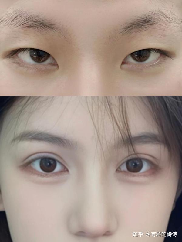 0|双眼皮已就位!各城市双眼皮医生