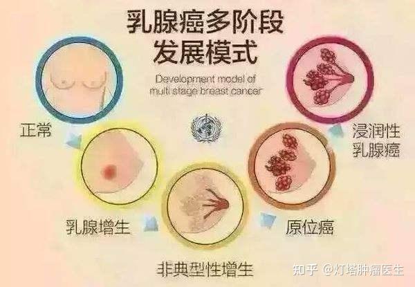 我们把它归为乳腺癌前病变,这类病变需要