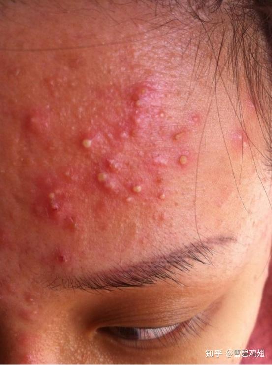我额头长那种红肿硬的痘痘,半个多月也没消,也不冒白头,我怎么才能让