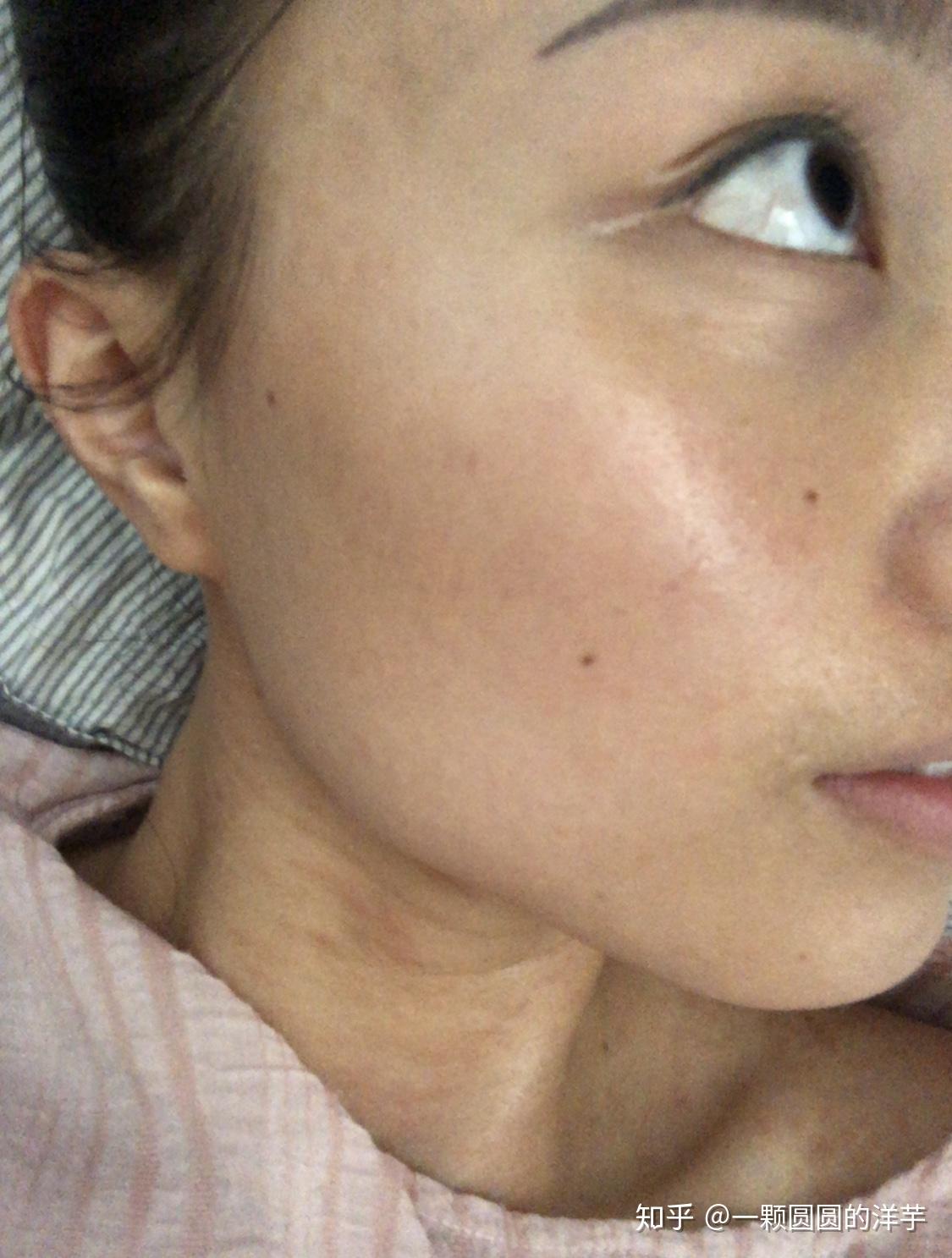 玫瑰糠疹的自愈以及平时要注意的