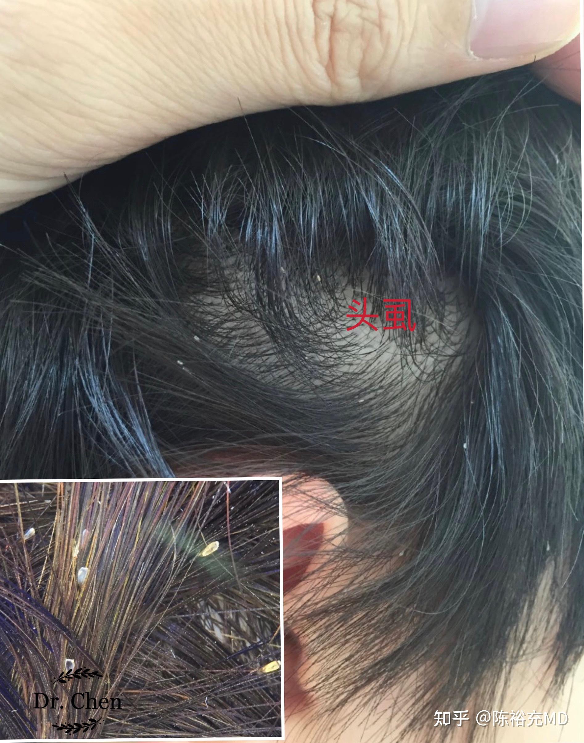 另外,头皮上还有一些其他疾病也会使人误以为是头皮屑,如毛发管型