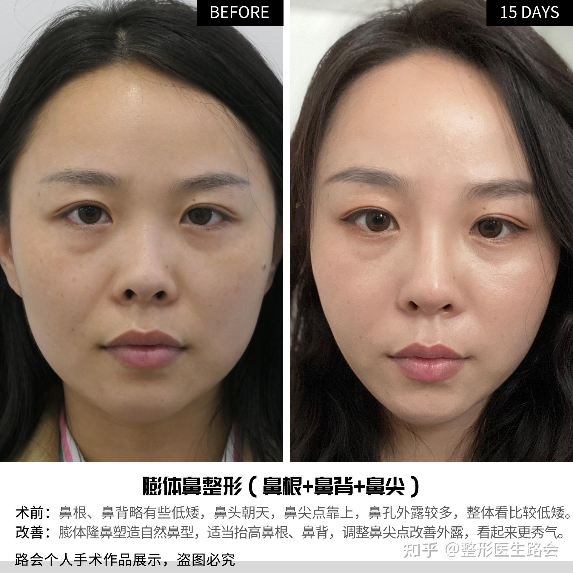 什么是朝天鼻?可纠正吗?