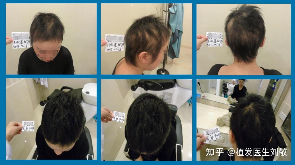 三,(美丝沛)中胚层疗法