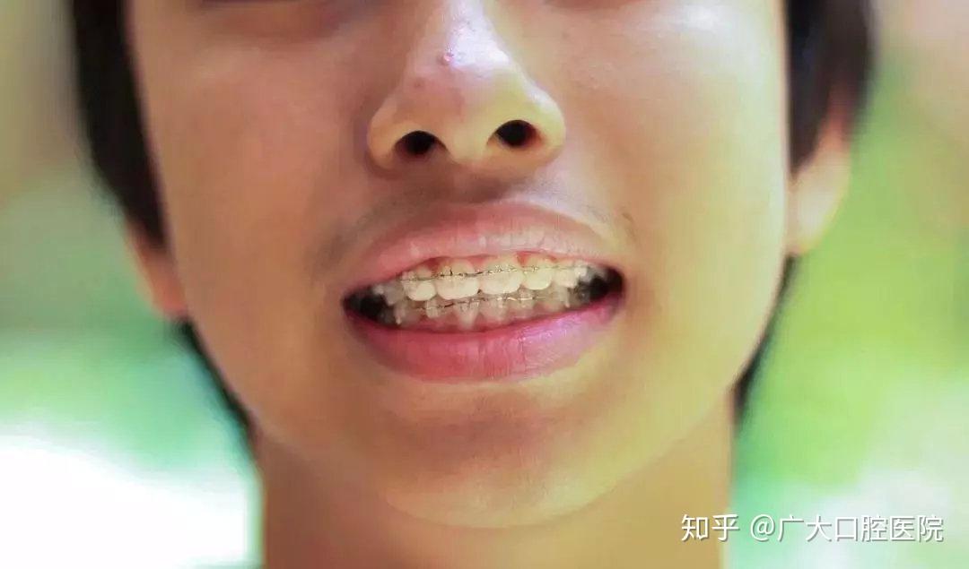 还有一种就是偏颌,由于牙齿咬合面不对称或者由于一边的牙齿龋坏或