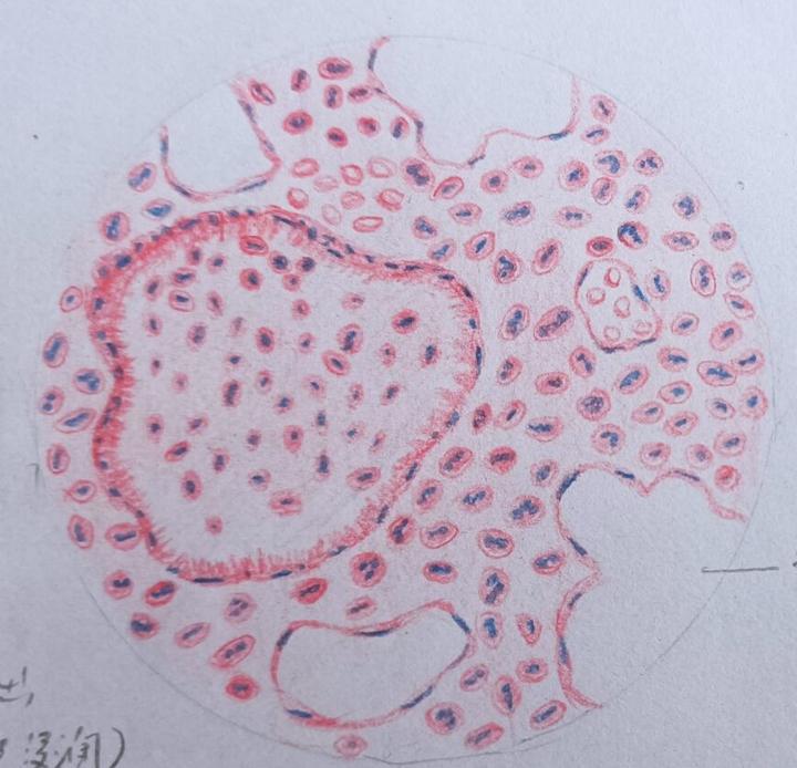 【病理学实验红蓝铅笔绘图】炎症