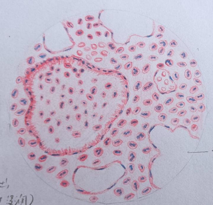 【病理学实验红蓝铅笔绘图】炎症