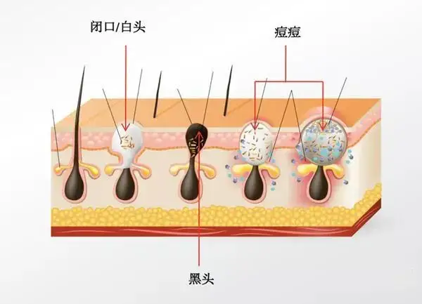 夏天闭口粉刺疯狂长怎么办? - 知乎