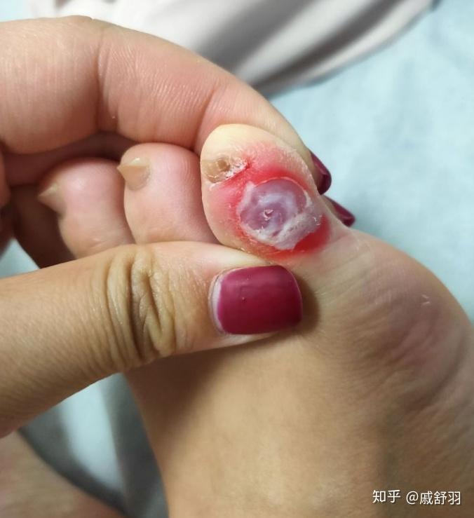 鸡眼这样好了吗