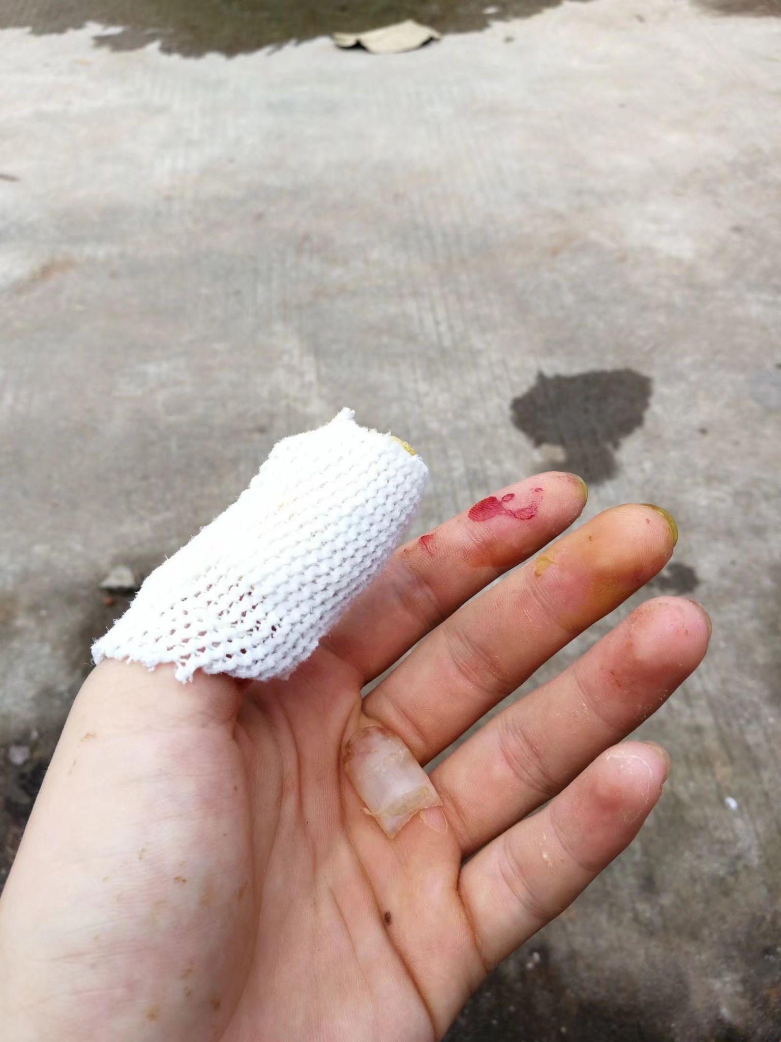 人被拔掉指甲后会怎样? - 知乎