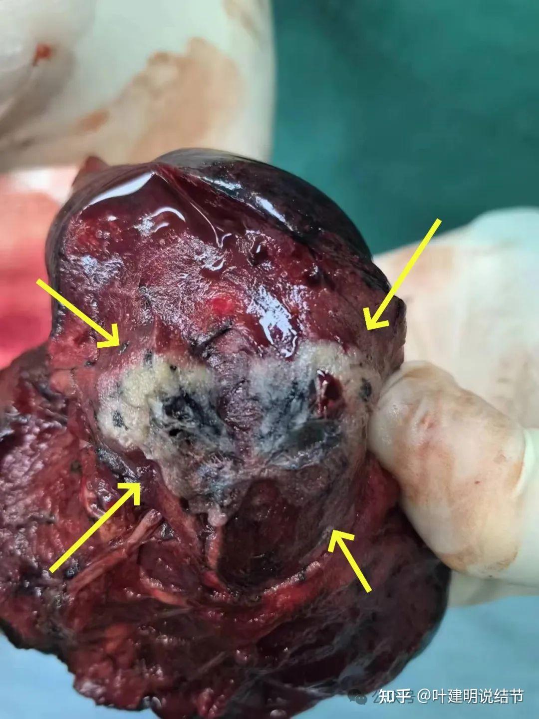 查出肺结节,医生说没事就真没事?
