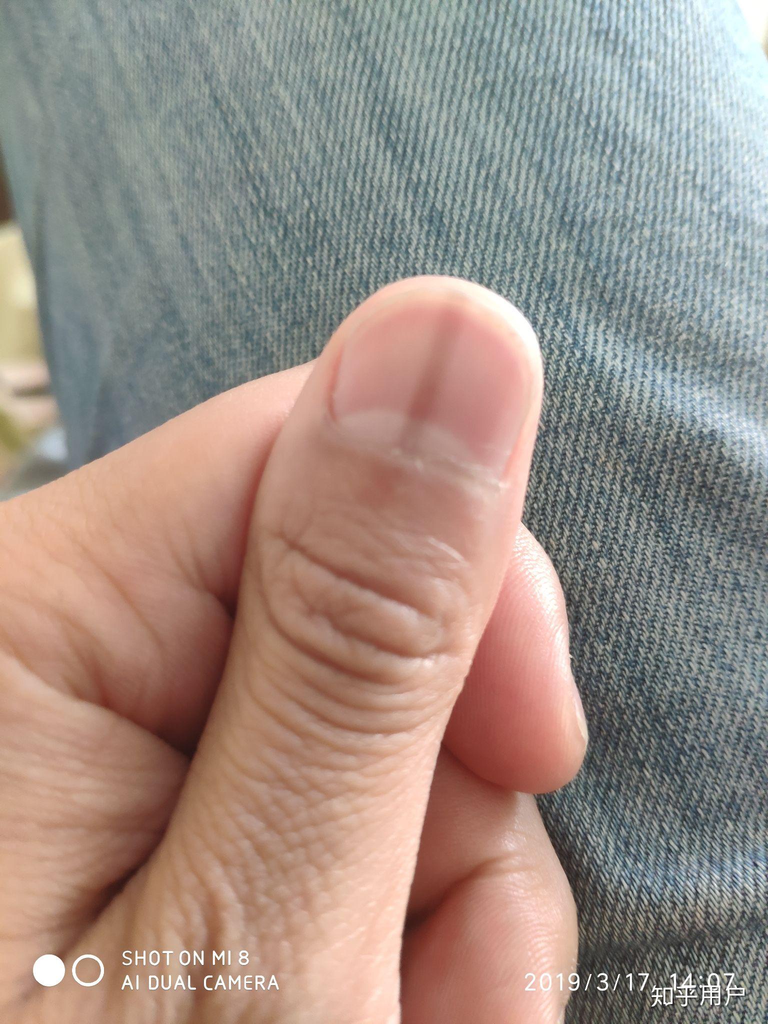 指甲上有一条淡淡黑线怎么回事两年了